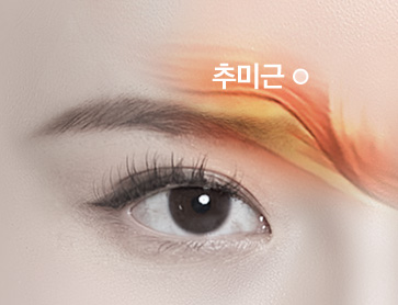 추미근 절제