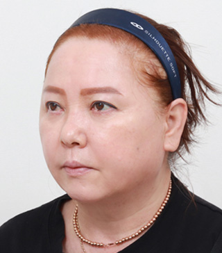 수술 3개월 후